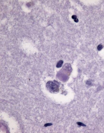 Dementia With Lewy Bodies Information