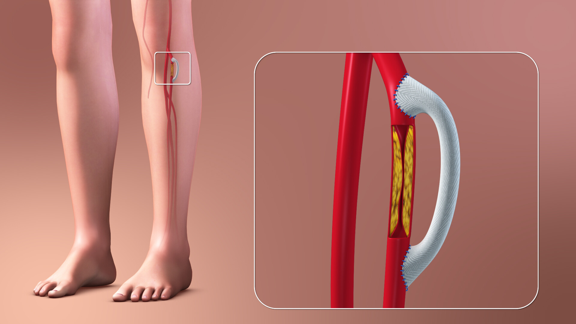 How Is Peripheral Artery Disease Treated? - StoryMD
