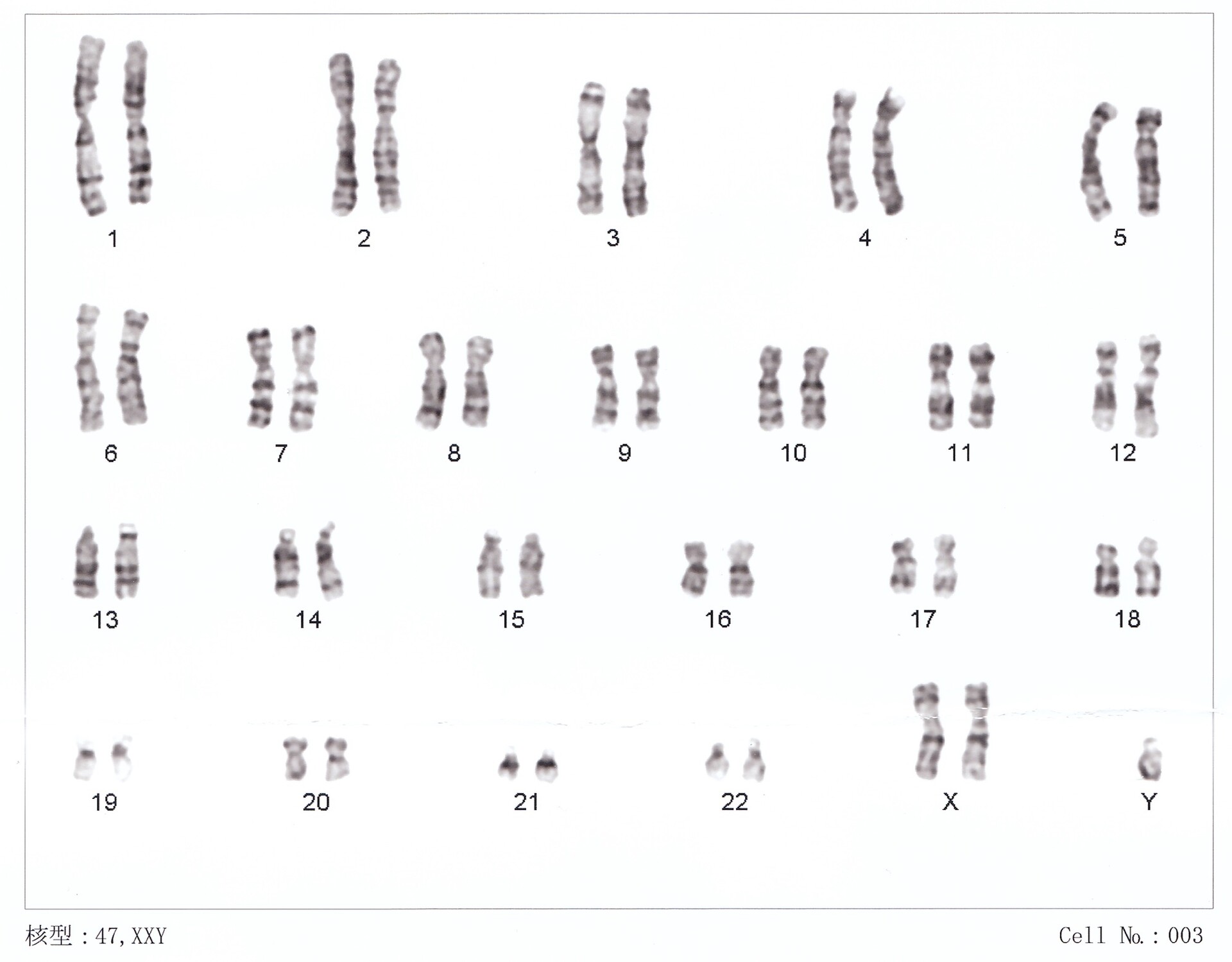 what-is-klinefelter-syndrome-storymd