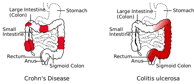 Types Of Ulcerative Colitis Ulcerative Colitis Ayurvedic Treatment