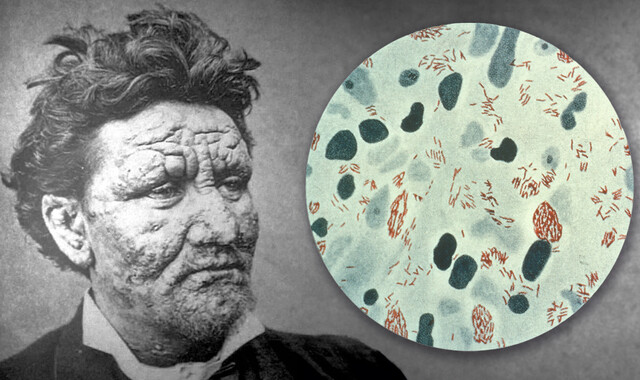 One of the World’s Oldest Diseases Is Nothing to Fear - StoryMD