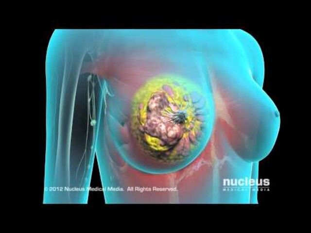 Breast Cancer - StoryMD