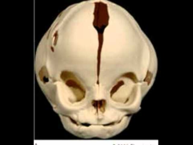 What Is Rubinstein-Taybi Syndrome? - StoryMD