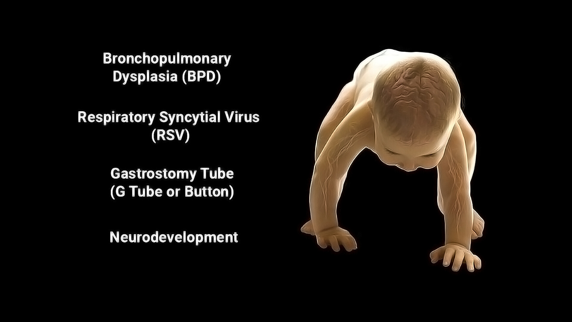 preventing-and-living-with-bronchopulmonary-dysplasia-storymd