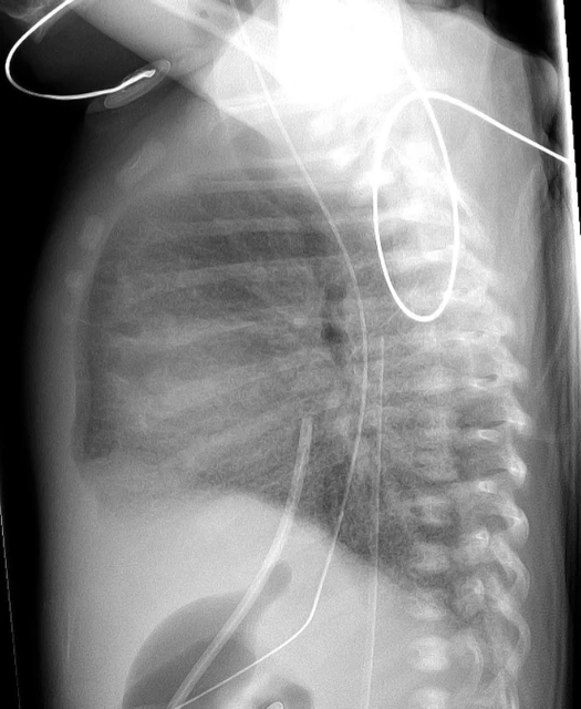Respiratory Distress Syndrome Baby