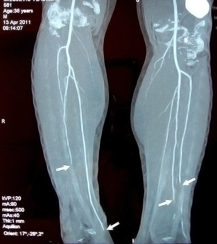 Smoking and Buerger’s Disease StoryMD