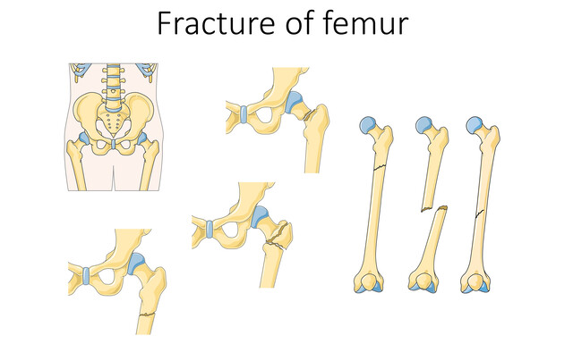 Minor Leg Injury Types
