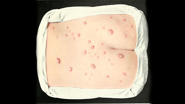 Staphylococcal Infections - StoryMD