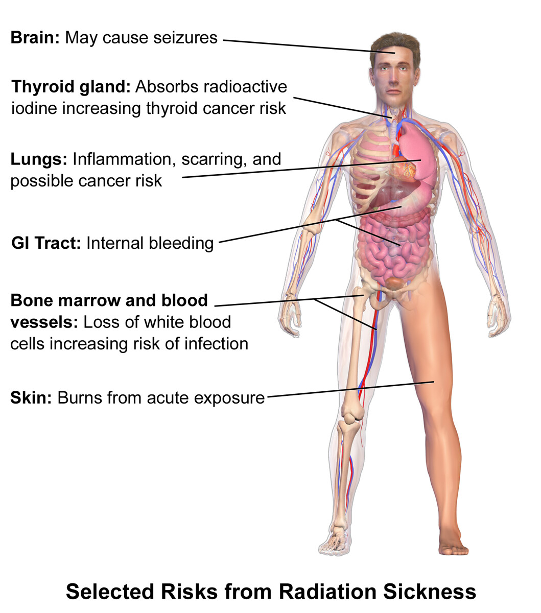 Acute Radiation Syndrome ARS Symptoms Exposure Testing