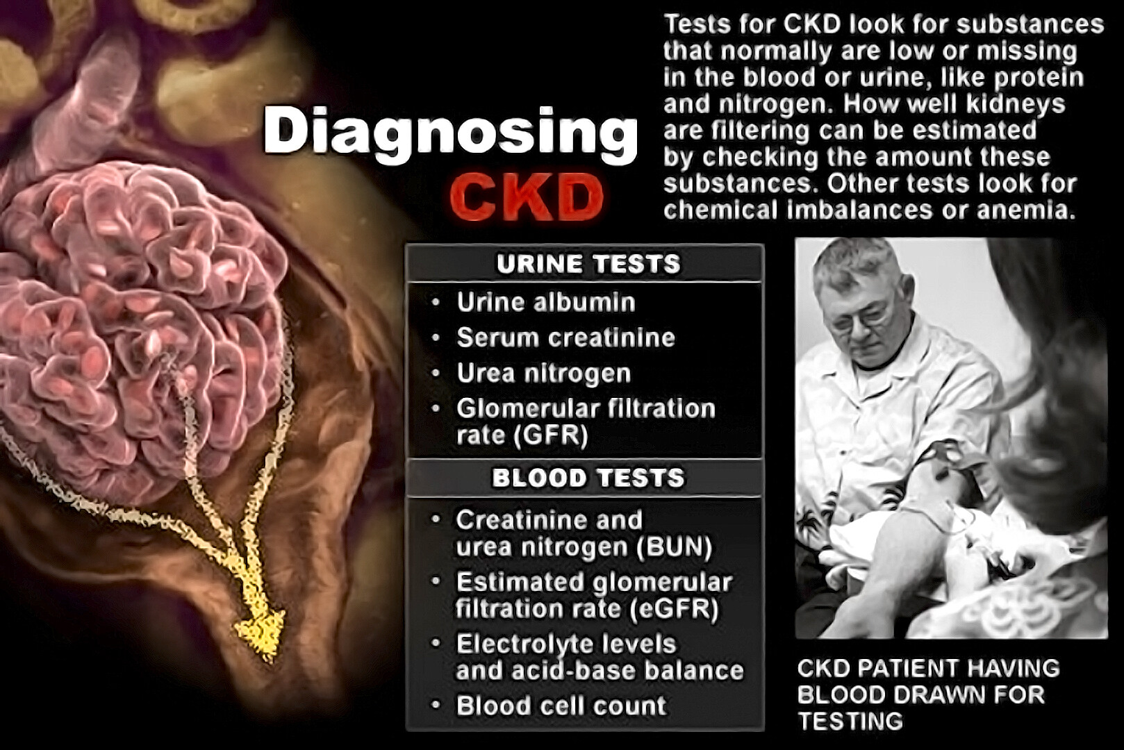 chronic-kidney-disease-tests-diagnosis-storymd