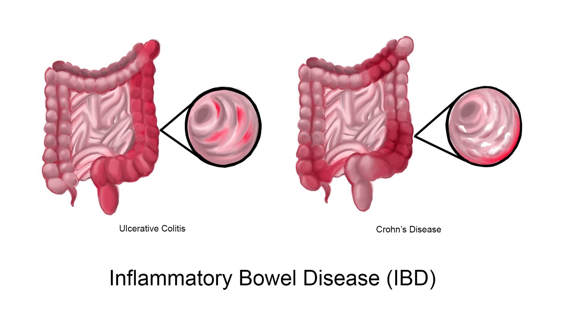 Inflammatory Bowel Disease (IBD): Types, Symptoms, and Management - Hudson  MD Group