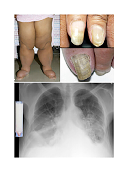 YELLOW NAIL SYNDROME RESOLUTION FOLLOWING TREATMENT OF PULMONARY  TUBERCULOSIS - PANG - 1993 - International Journal of Dermatology - Wiley  Online Library