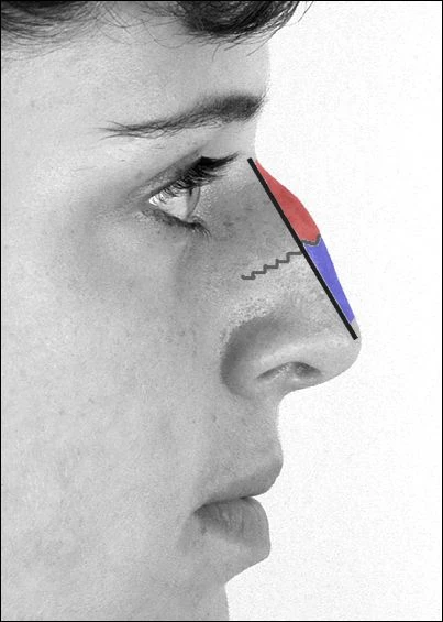 Nose Surgery (Rhinoplasty) - StoryMD