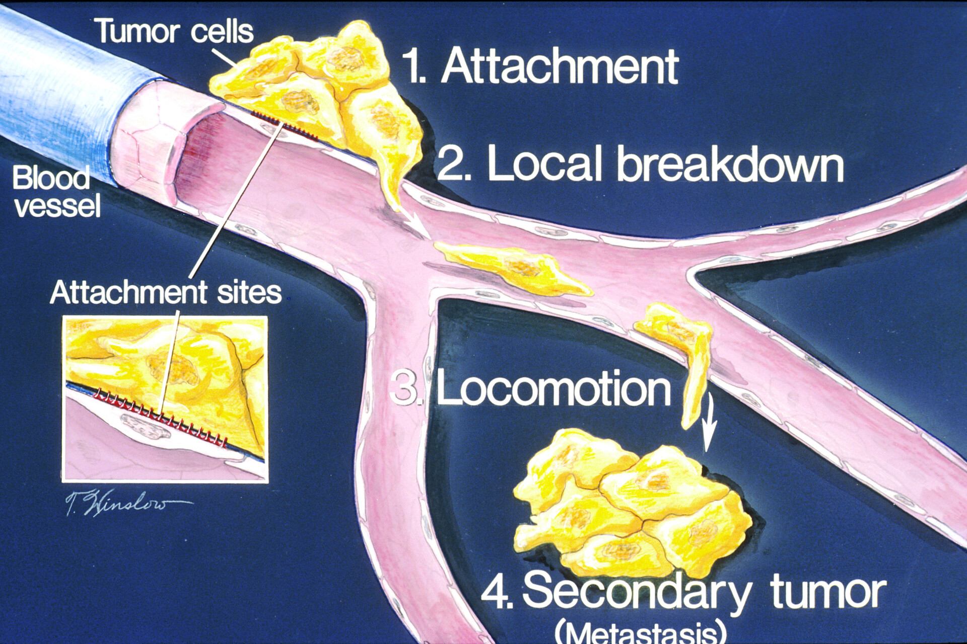 Breast Cancer - StoryMD