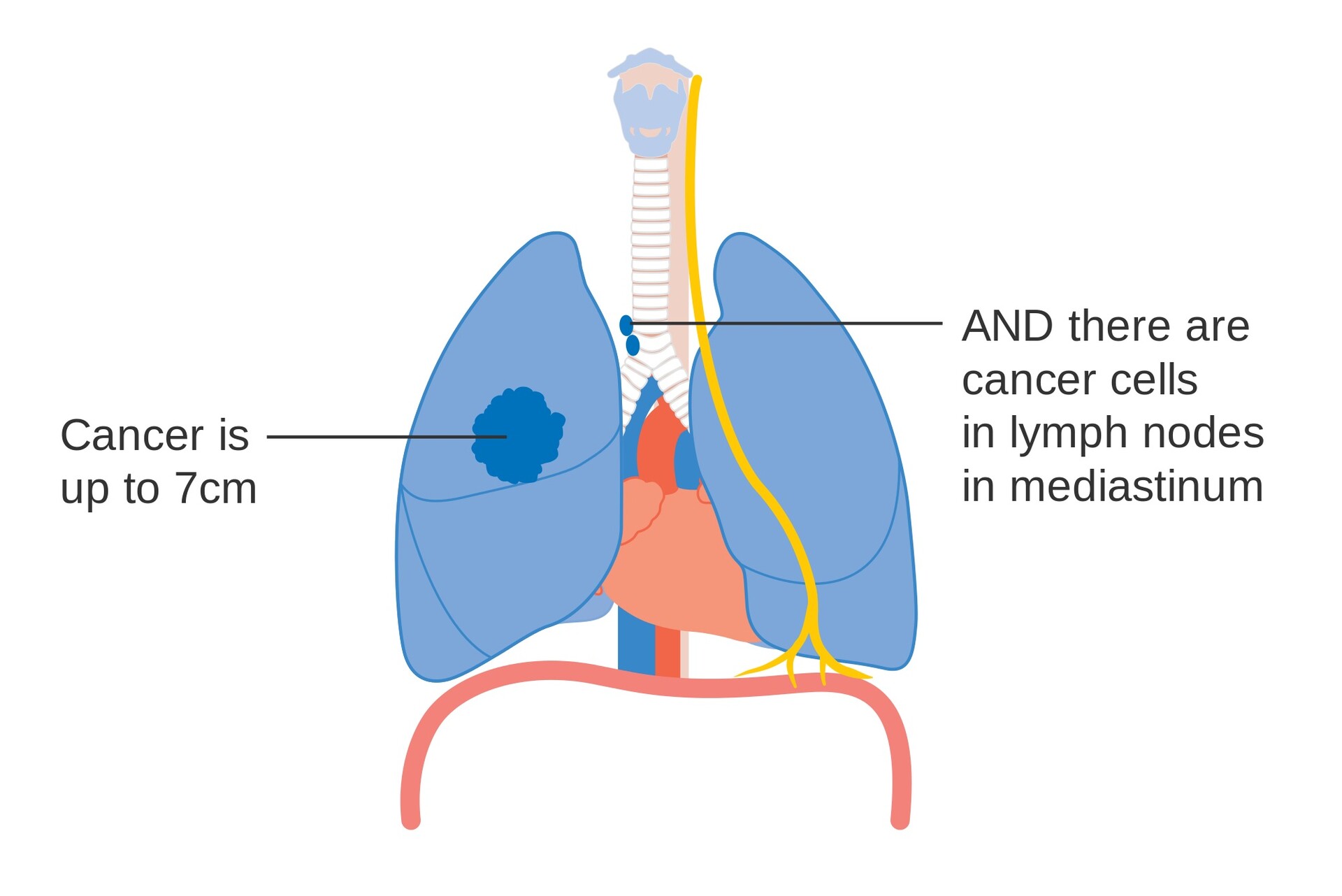 Stages Of Lung Cancer Diagram