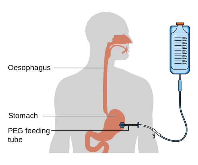 Venting Peg Which G Tube To Use In Pullers: Assessment Of Pull
