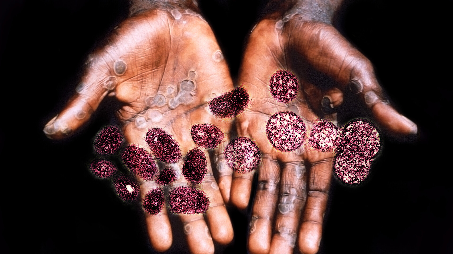 Mpox (Monkeypox): Signs, Symptoms, and Complications