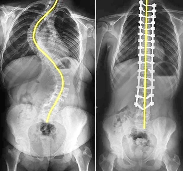 How Is Scoliosis Treated? - StoryMD