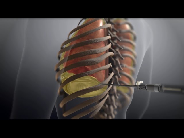 Thoracentesis - StoryMD