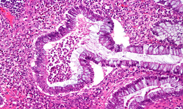 What Is Ulcerative Proctitis?