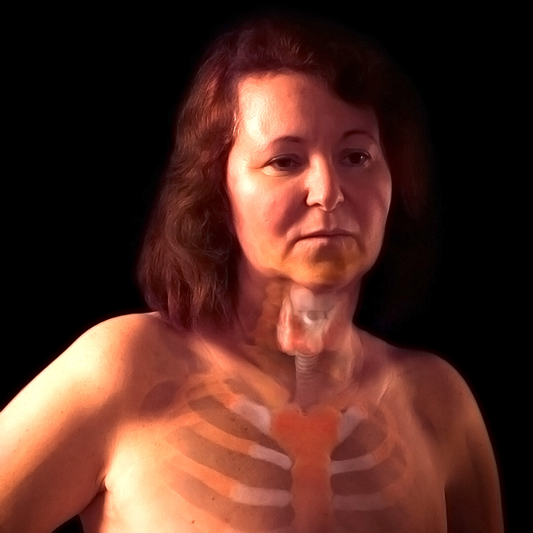 Thyroid cancer journey storymd