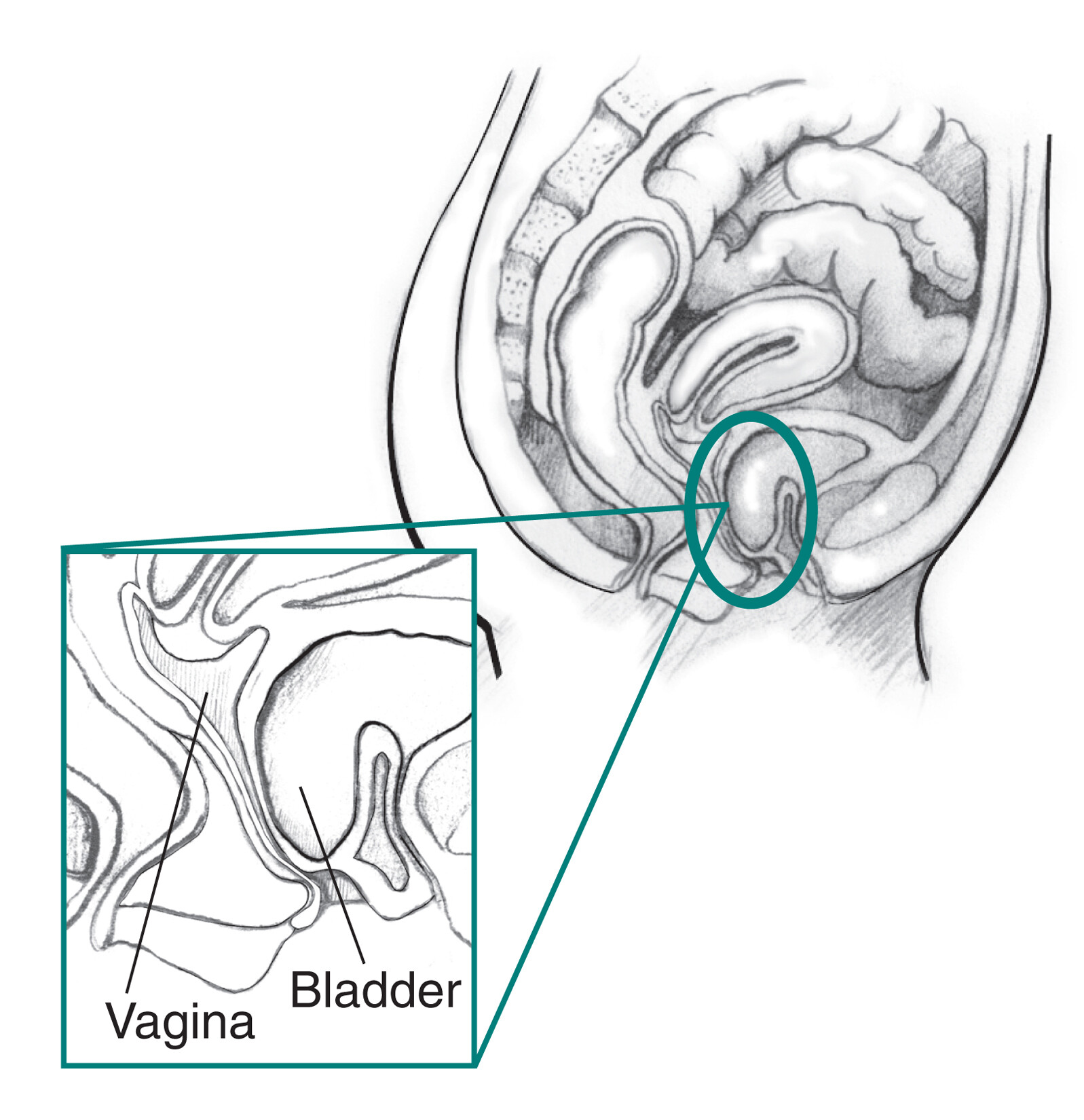 A cystocele is also known as a bladder - Stock Illustration