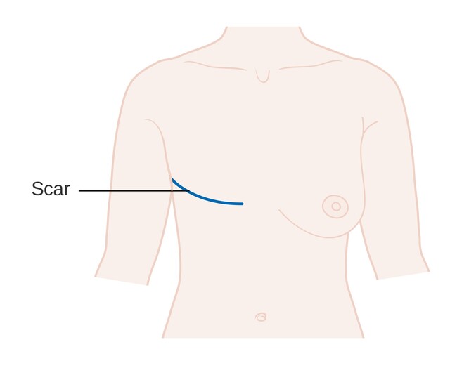 Mastectomy: What You Need to Know
