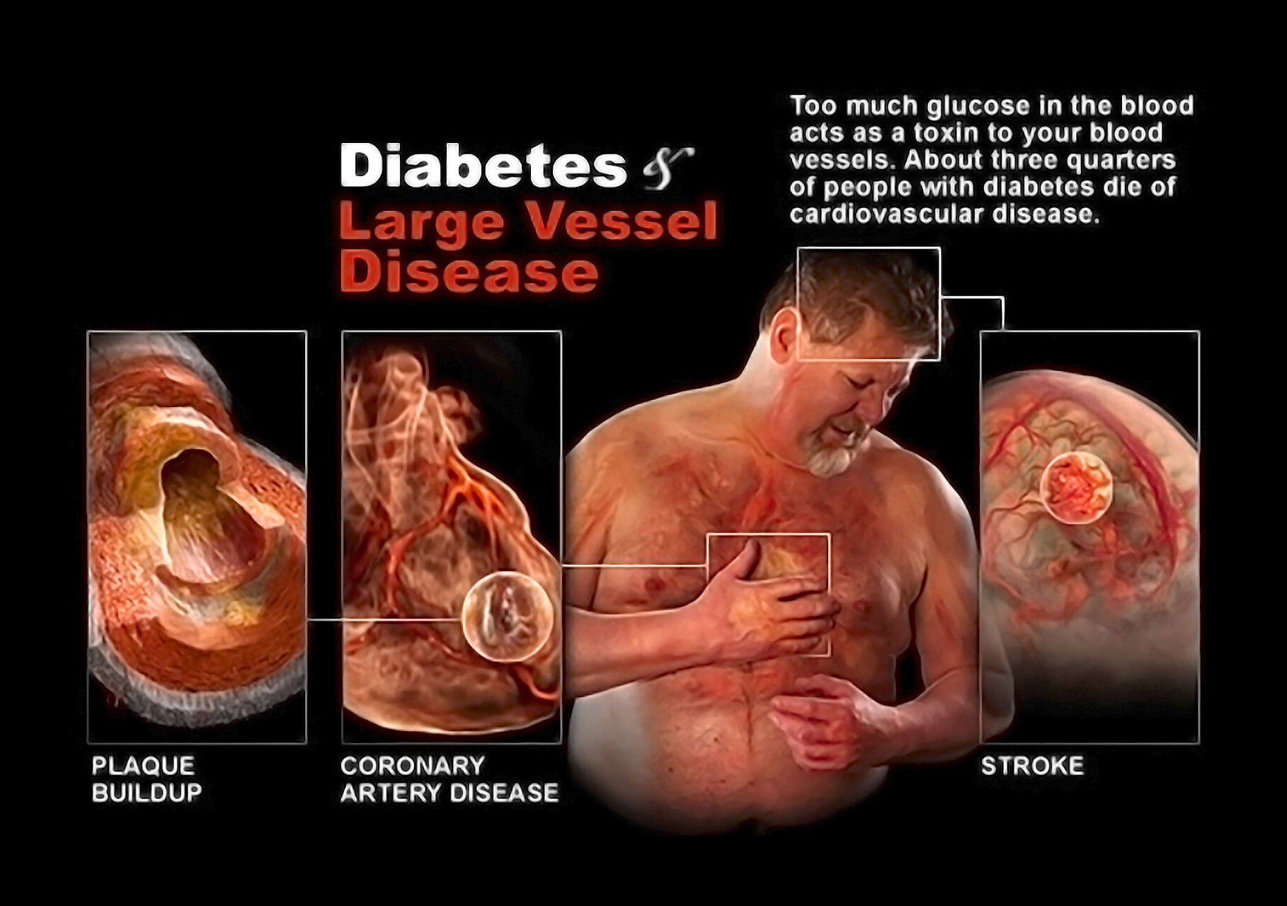 Diabetic Heart Disease   StoryMD