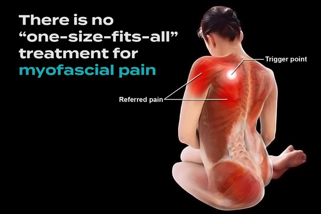 What To Know About Myofascial Pain Syndrome