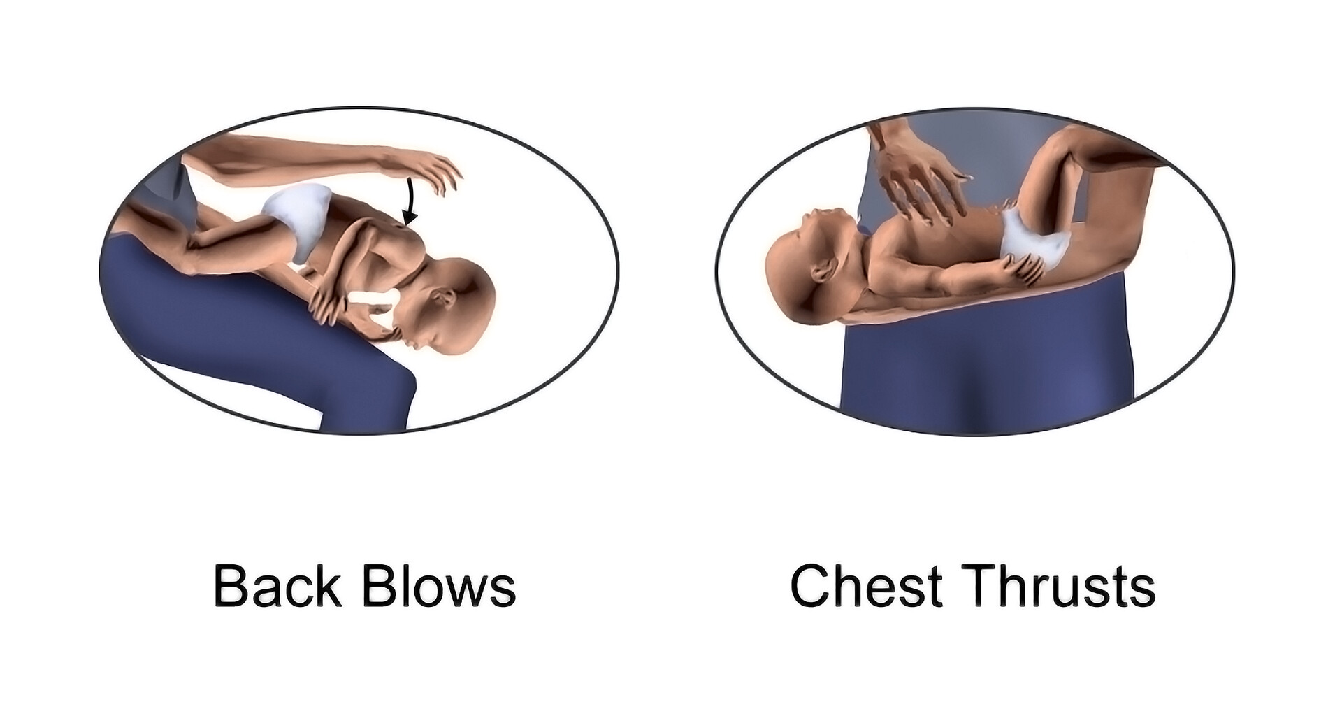 abdominal thrusts steps