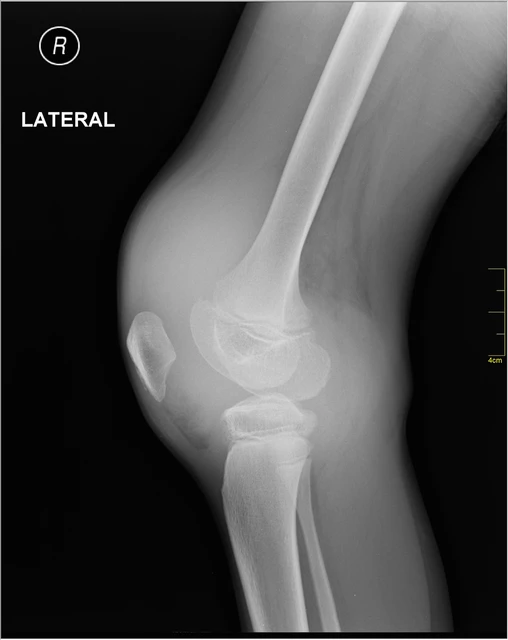 Hemophilia without prophylaxis: Assessment of joint range of