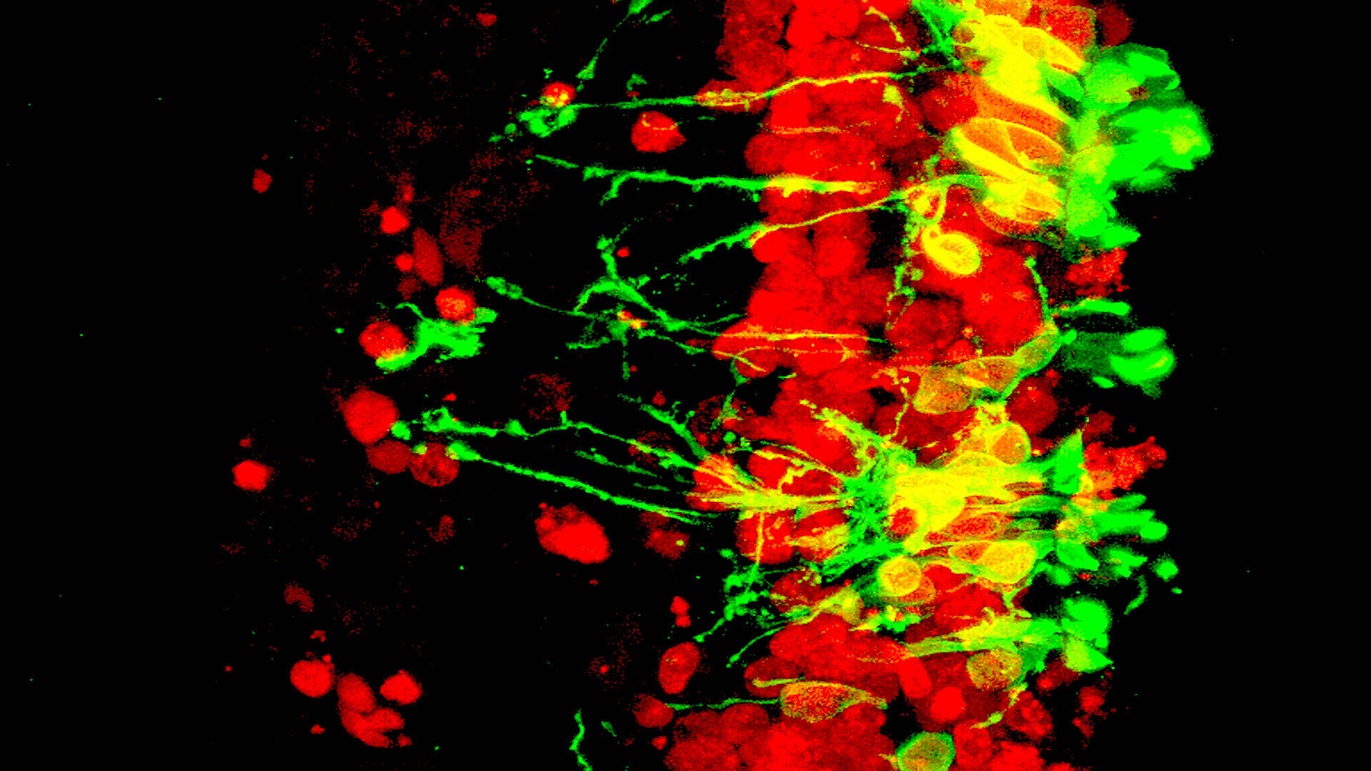 What Is Neuropathy, Ataxia, and Retinitis Pigmentosa? StoryMD