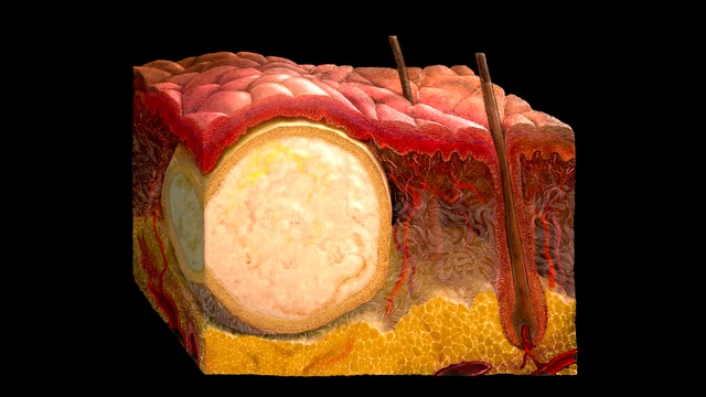 Sciatica - StoryMD