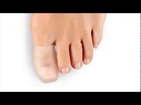 Hammer Toe or Mallet Toe, Causes, Signs and Symptoms, Diagnosis and  Treatment. 