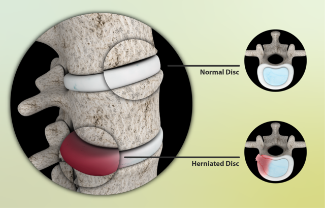 Sciatica - StoryMD