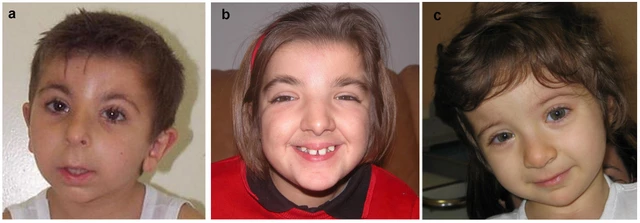 Facial features of Rubinstein-Taybi syndrome