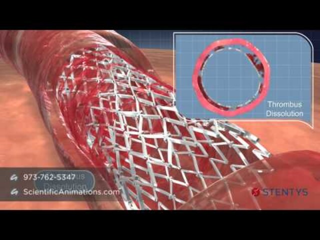 What to Expect After Getting a Stent - StoryMD