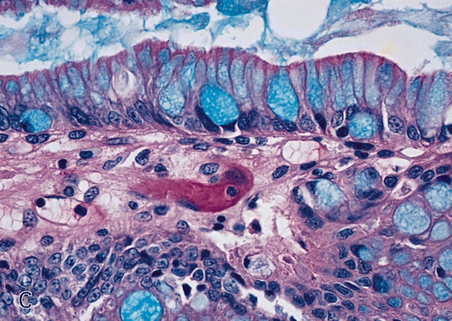 Barrett's Esophagus Risk Factors, Causes, Symptoms, Treatment StoryMD