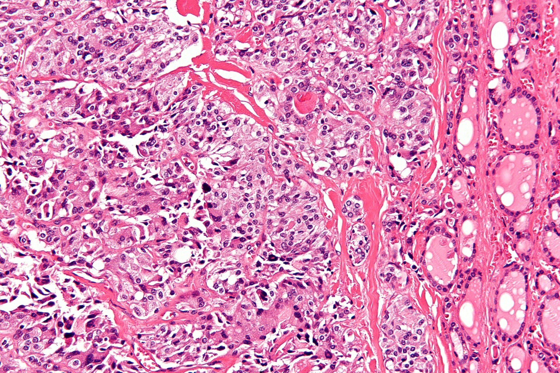 Multiple Endocrine Neoplasia Type 2A - StoryMD