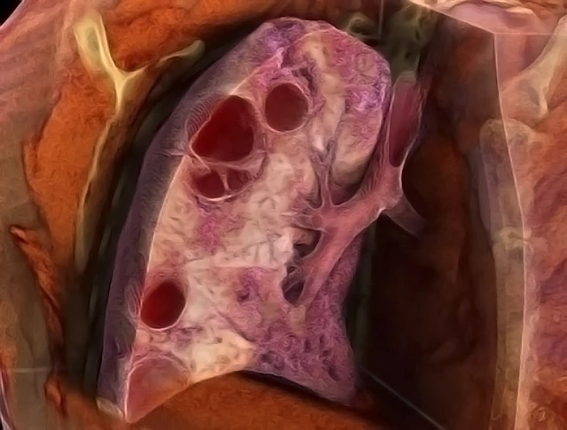 Outbreak of Lung Injury Associated with the Use of E-Cigarette, or Vaping,  Products - StoryMD
