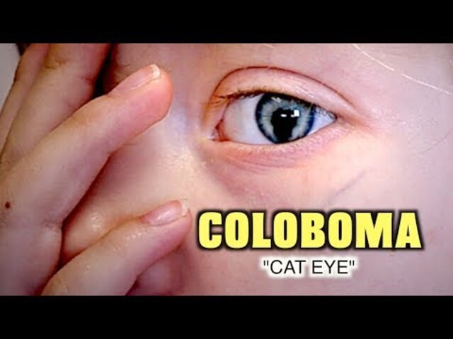 cat eye syndrome statistics