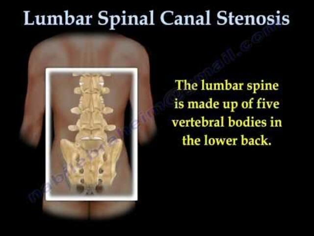 Acute Low Back Pain , Lumbar Disc Herniation - Everything You Need To Know  - Dr. Nabil Ebraheim 