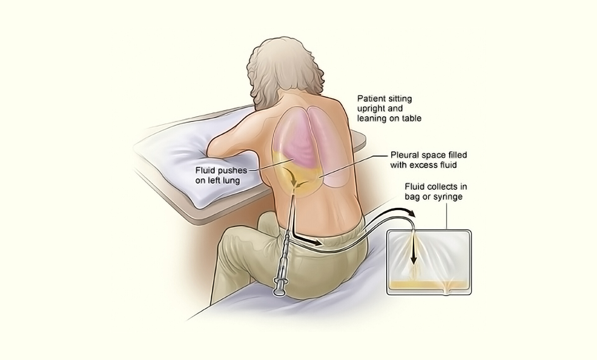 Thoracentesis - StoryMD