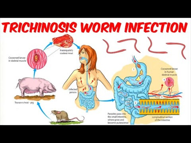 Trichinella Life Cycle Trichinellosis: Causes, Symptoms, Prevention