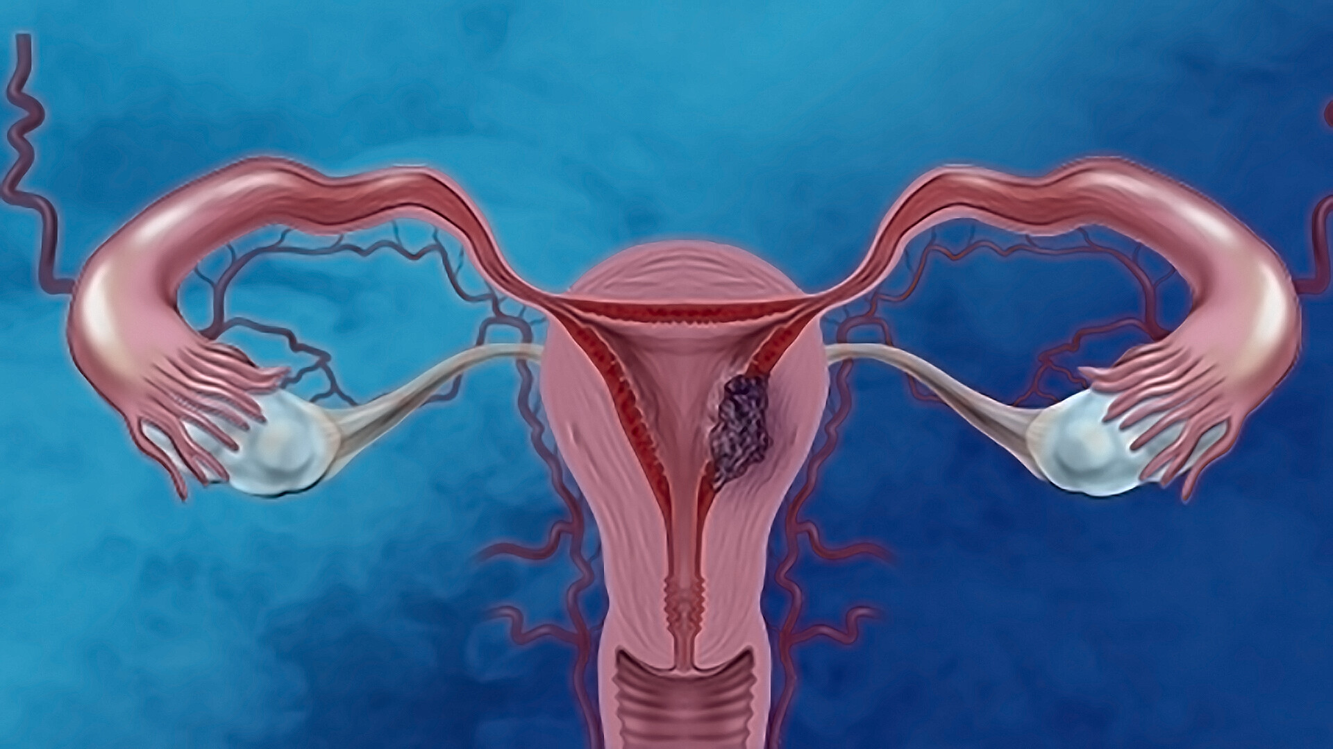 Endometriosis happens when tissue similar to the lining of the