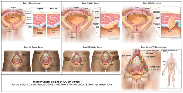 Bladder Cancer Staging