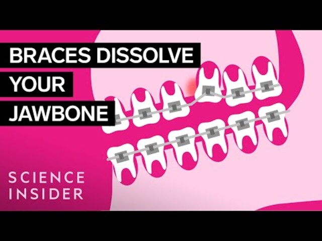 How Braces Work- Elements of the orthodontic treatment and its