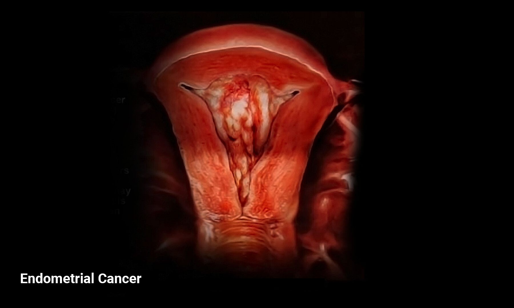 What Is Endometrial Cancer? - StoryMD