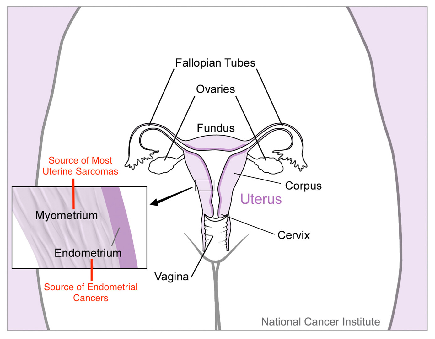 Endometrial Cancer Treatment - NCI