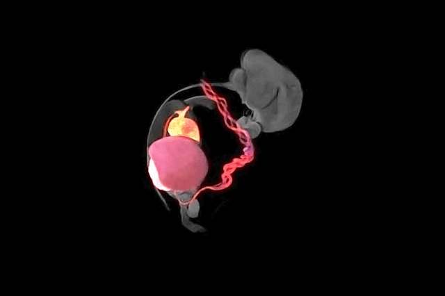 Urachal Cyst - Maiden Lane Medical